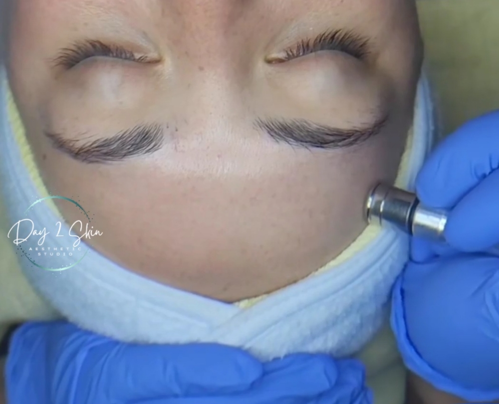 Microdermabrasion FACIAL