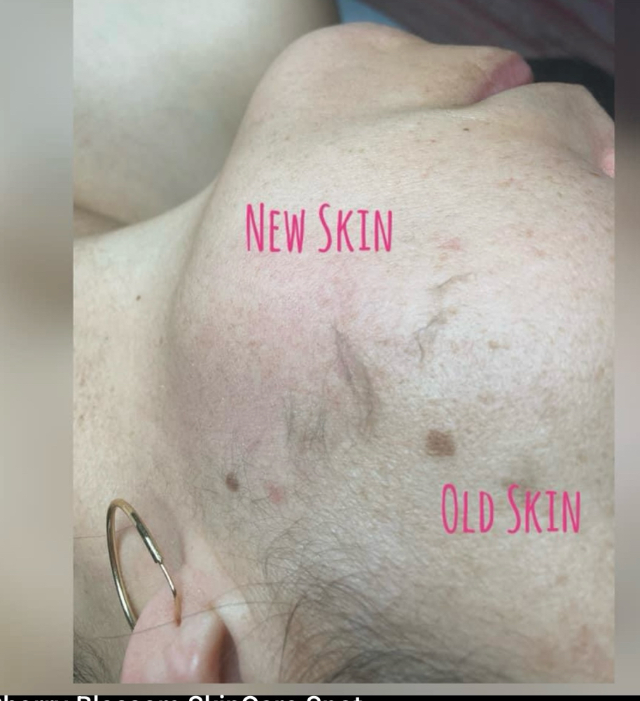 Demaplane facial