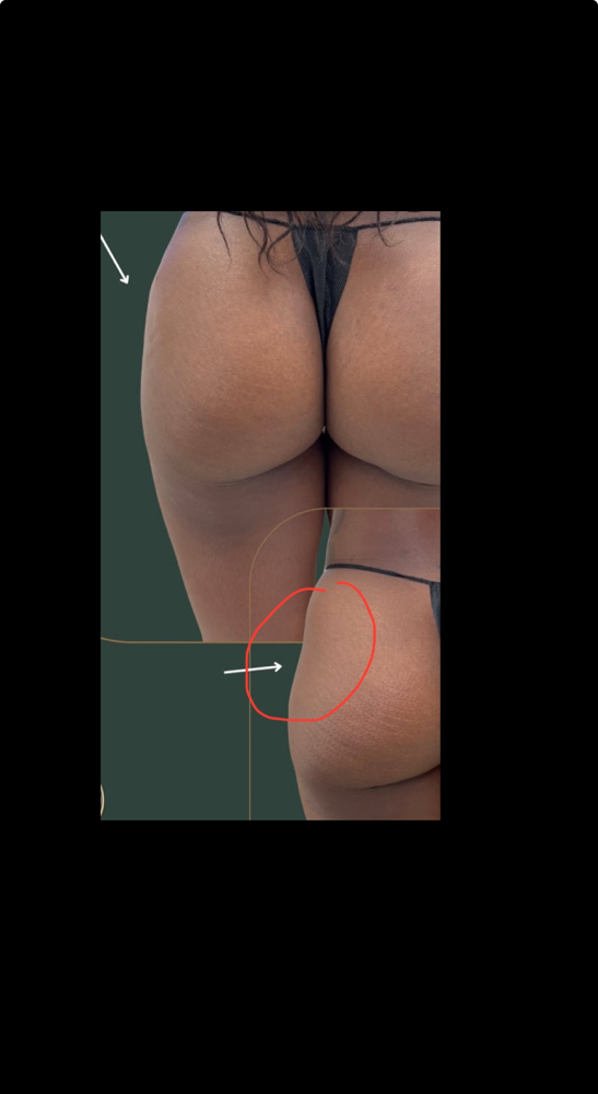 Sculptra or Radiesse BUTT LIFT