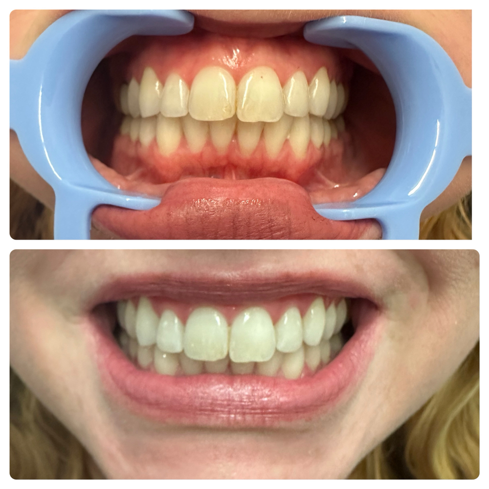 Divinci Teeth Whitening