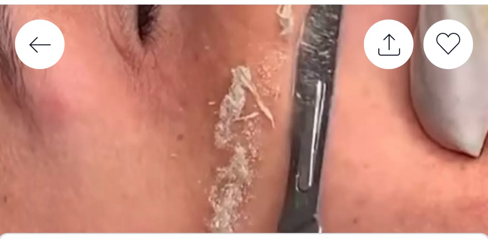 Dermaplaning