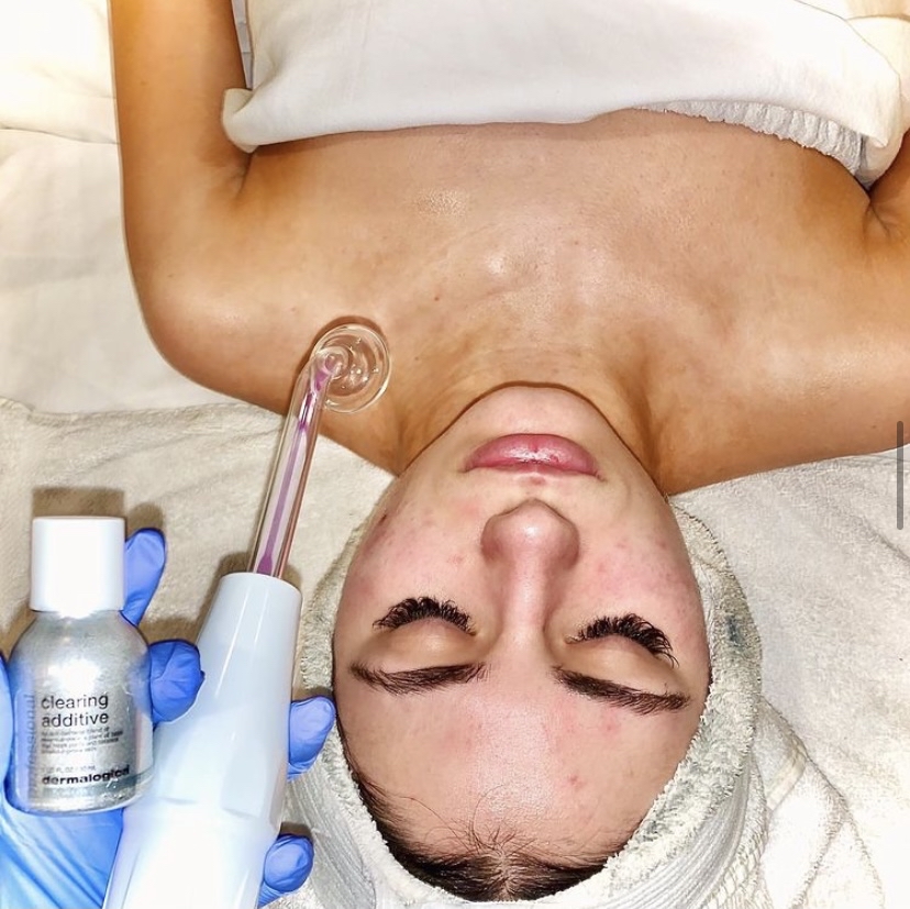 Acne Facial