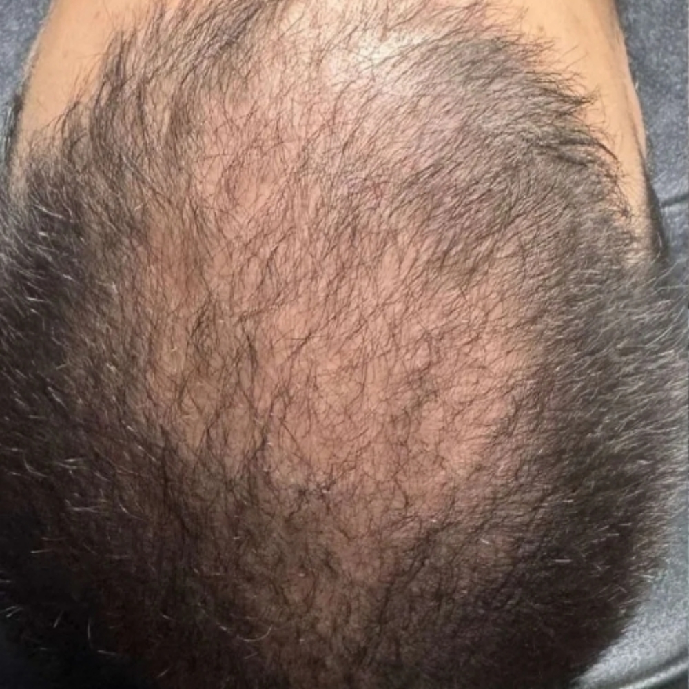 HAIR RESTORATION at TIMELESS INK in Orlando, FL