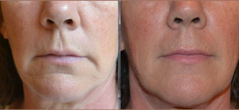 Lower Face Lift (Marionette Filler)