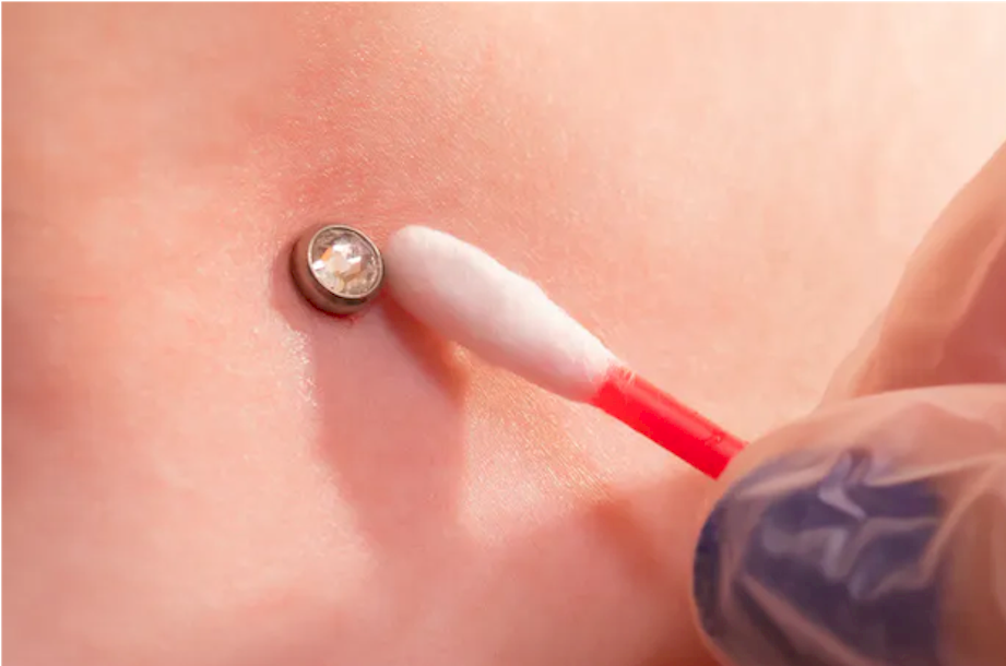 Microdermal removal