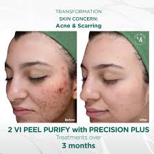 prescision plus w purify VI peel