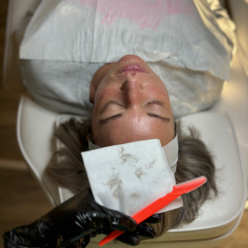 Dermaplaning Treatment