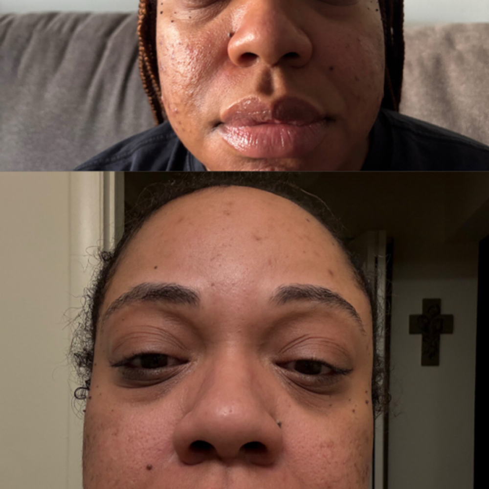 Virtual Clear Skin Boot Camp