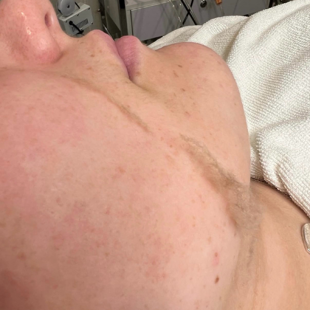 DermaFlash Add On at SKIN by Christine Russell in Green Bay, WI