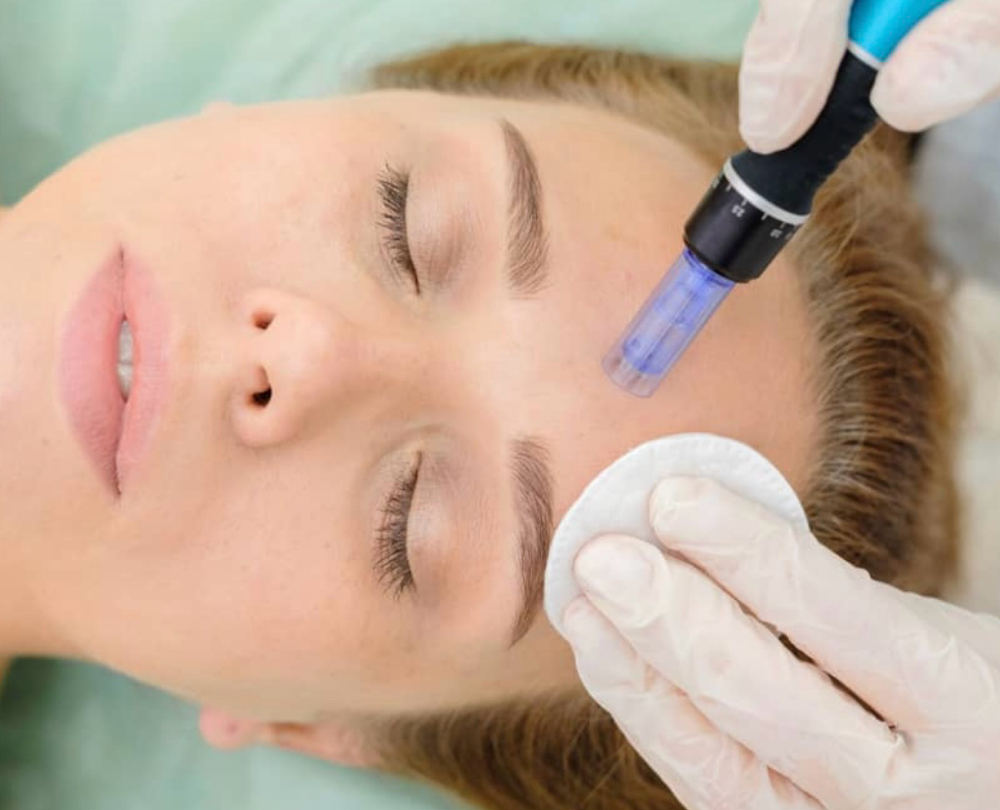 Microneedling