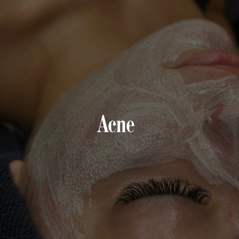 Acne Fighting Facial