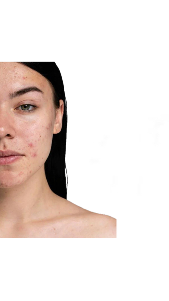 ACNE RELIEF