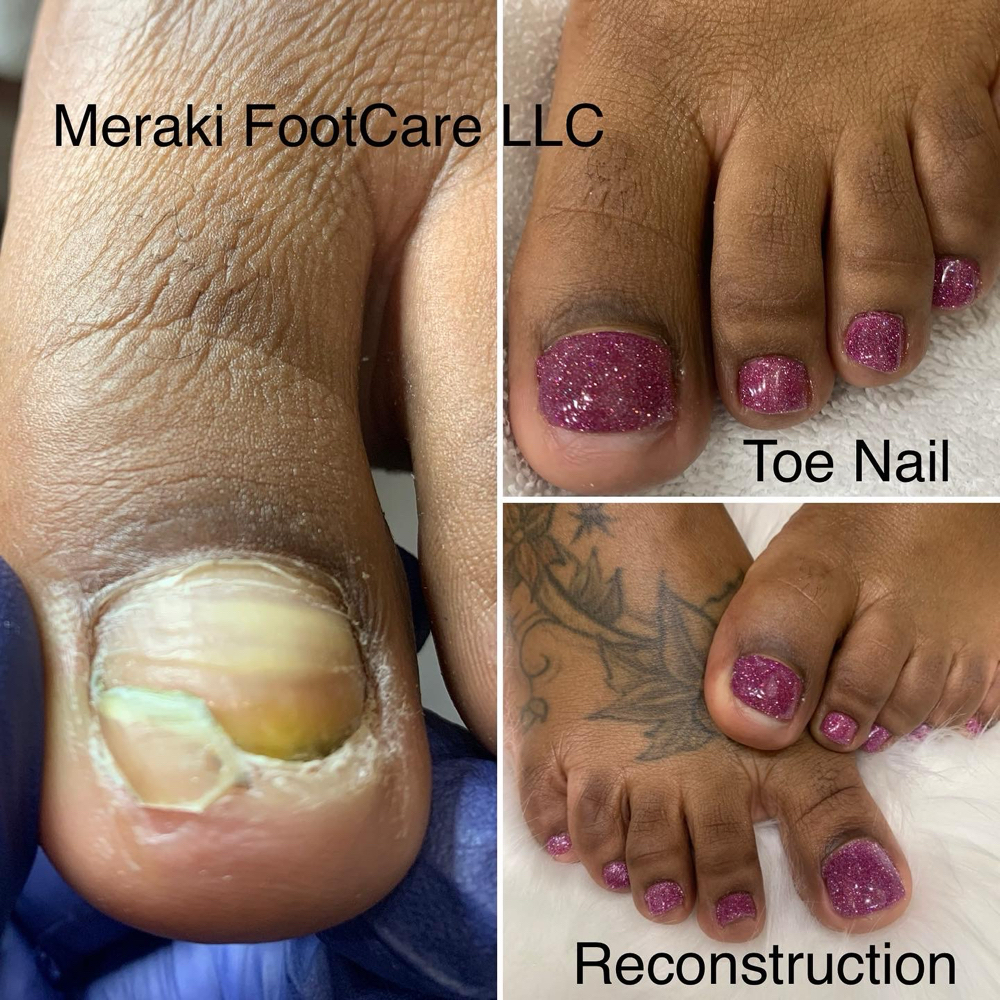 Toenail Restoration (Add-On Only) at Meraki FootCare in Dayton, OH