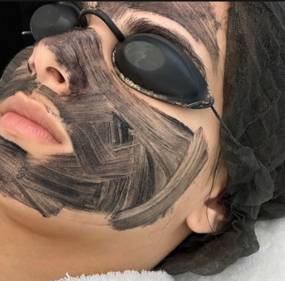 Peeling De Carbono at Jessica Luchesi Skin Wellness in Elizabeth, NJ