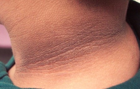 Neck Lightening (1 Treatment)