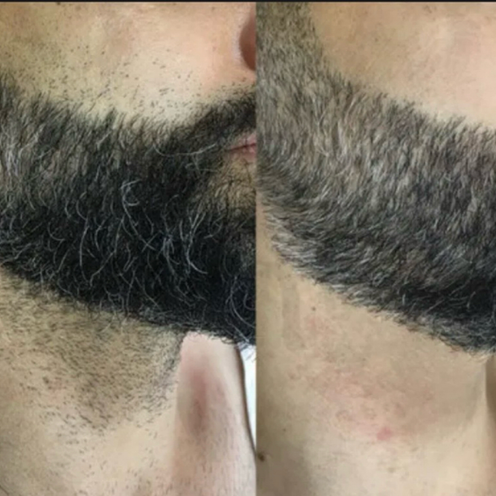 Beard/Neck Laser Single Session at Blessed & Bare Laser Studio in New York, NY