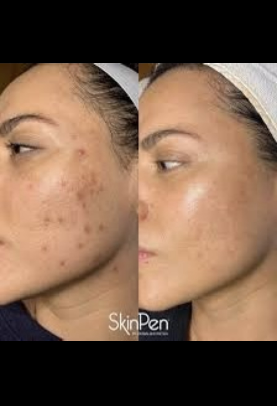 SkinPen Microneedling pckge x3