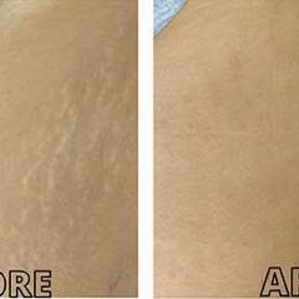 Inkless Stretch Mark Revision at Haus of Beauty Studio in Hialeah, FL