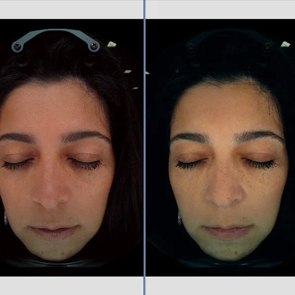 3D Skin Analysis + Treatment Plan at 360 Med Spa Buford in Buford, GA