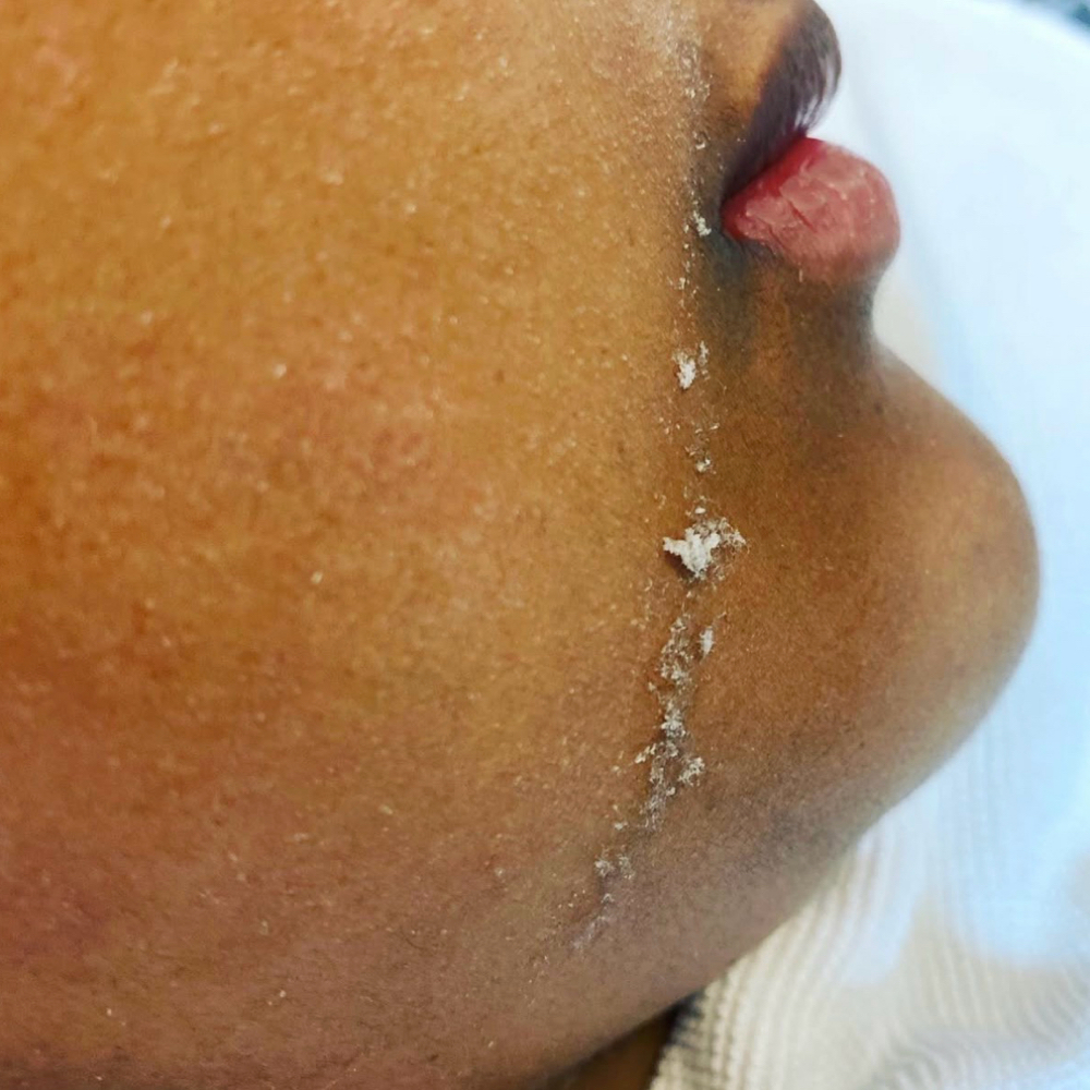 DermaFlash Express at SKIN by Christine Russell in Green Bay, WI