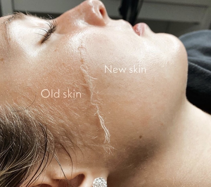 Add On Dermaplane