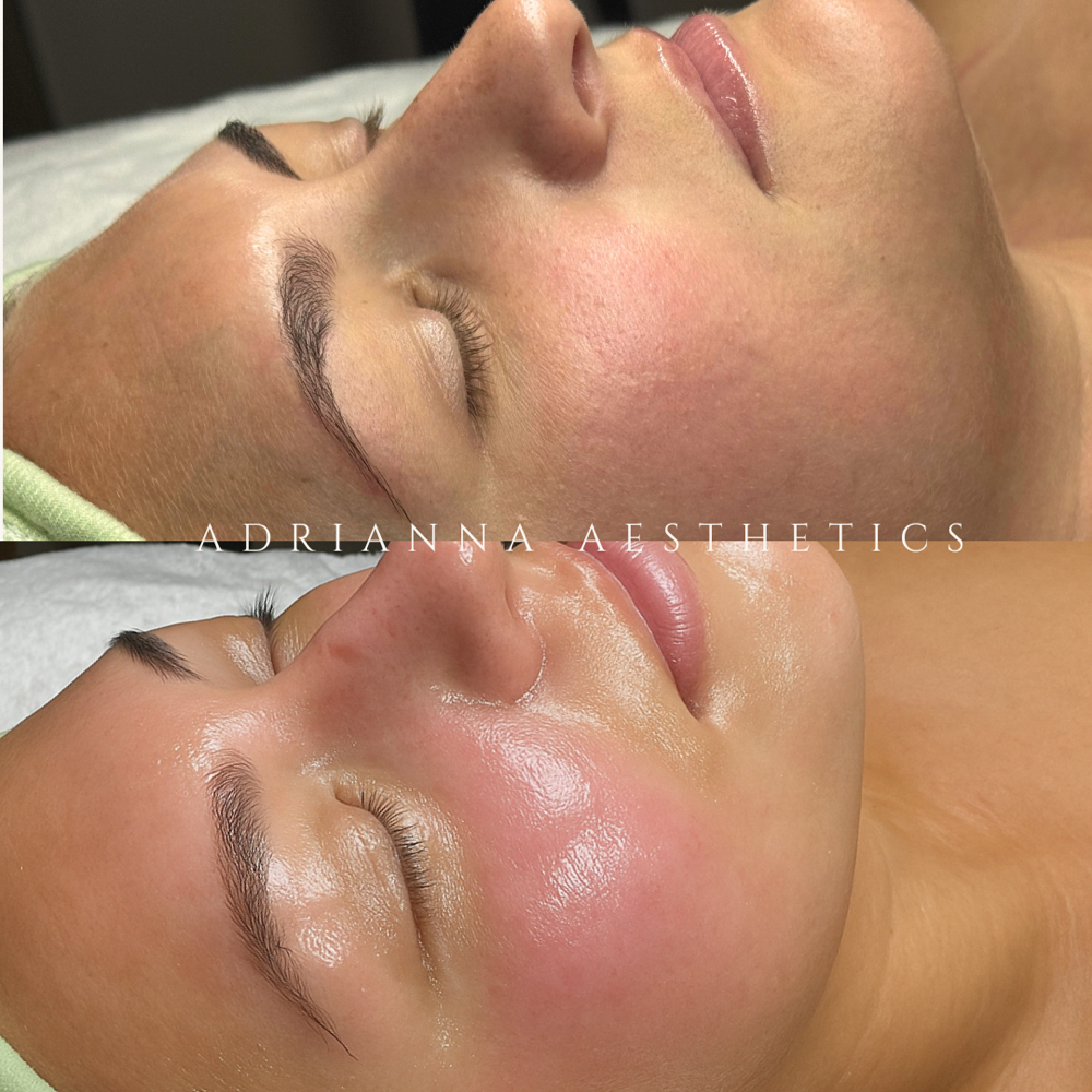 Advanced Resurfacing