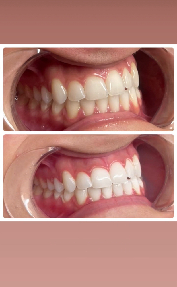 Teeth Whitening
