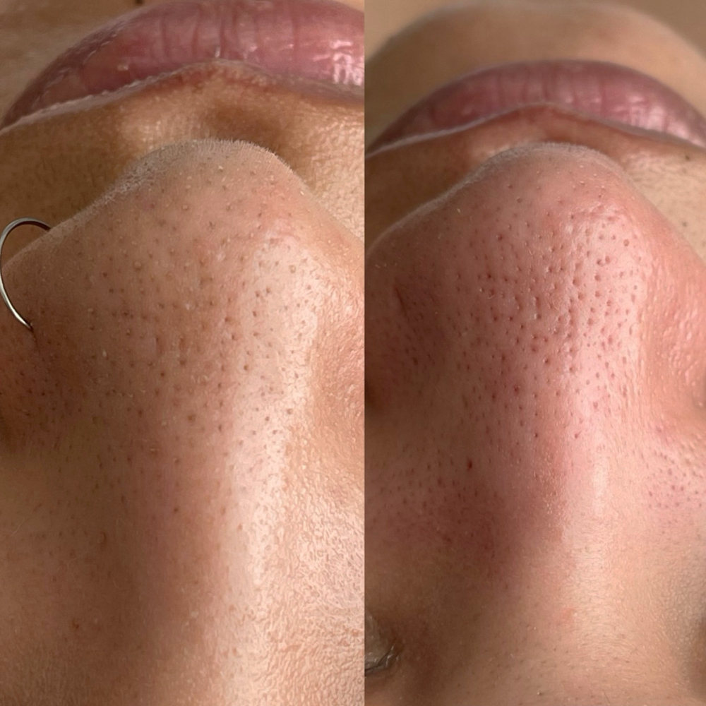 Deep Cleansing Facial