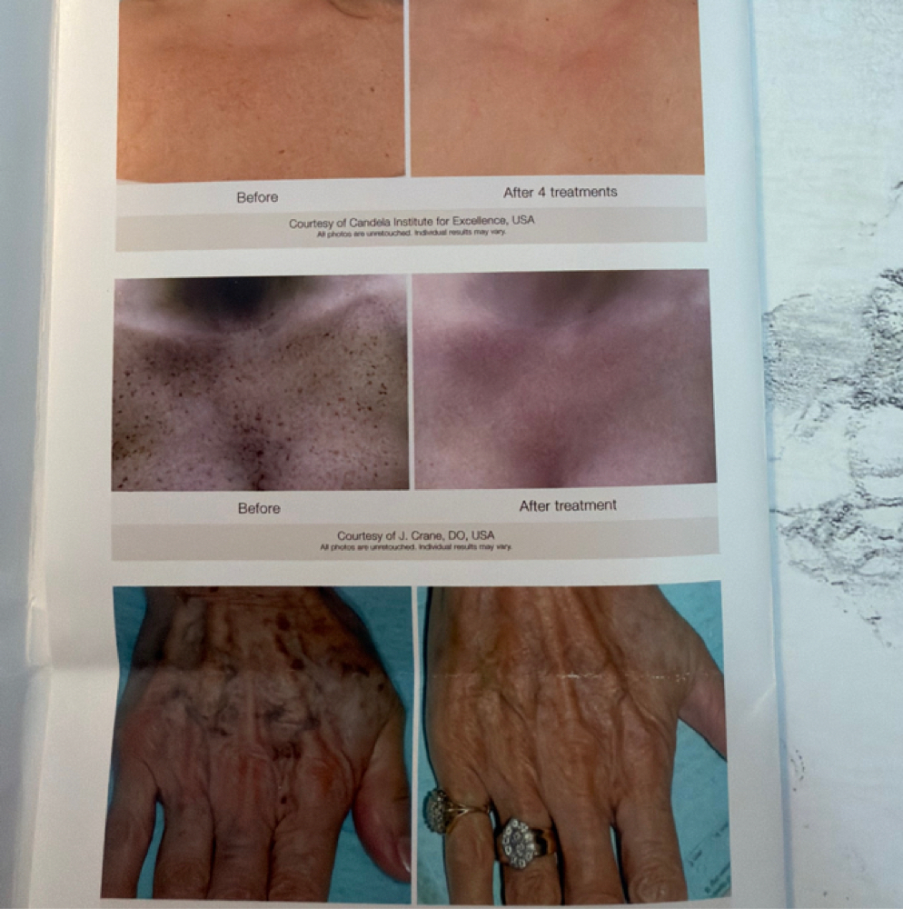 Precision Pigment Laser Therapy at Studio Lux Beauty Bar    Esthetics by Delanie & Lindsey in Mineola, TX