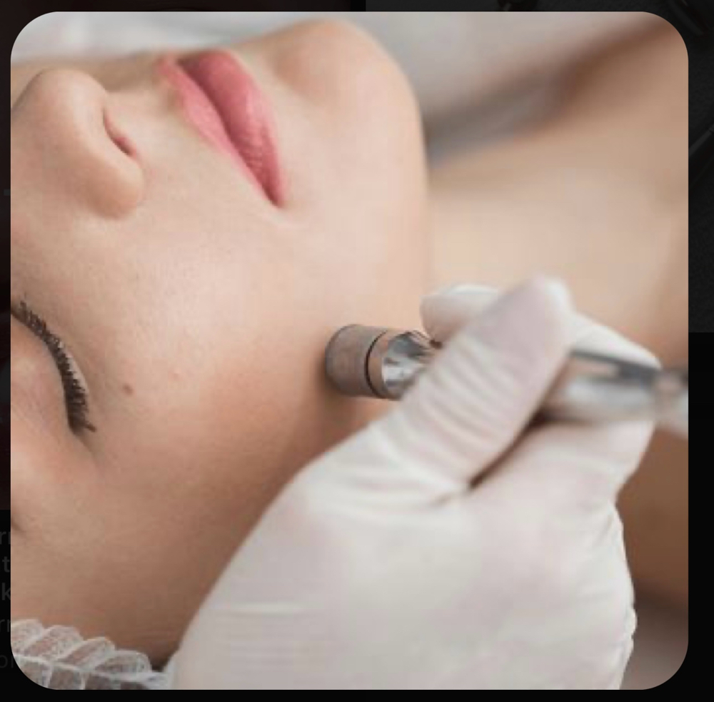 Diamond Microdermabrasion Facial