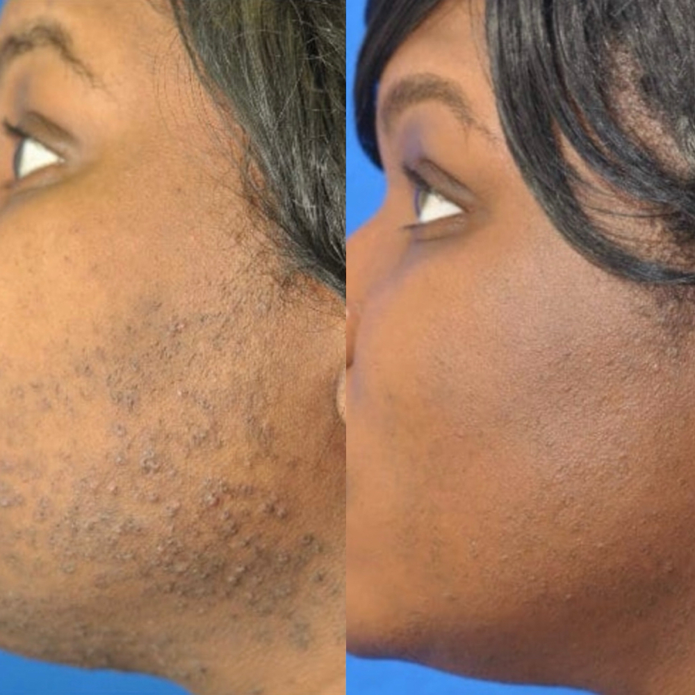 Cheeks Laser - 5 Sessions at Blessed & Bare Laser Studio in New York, NY