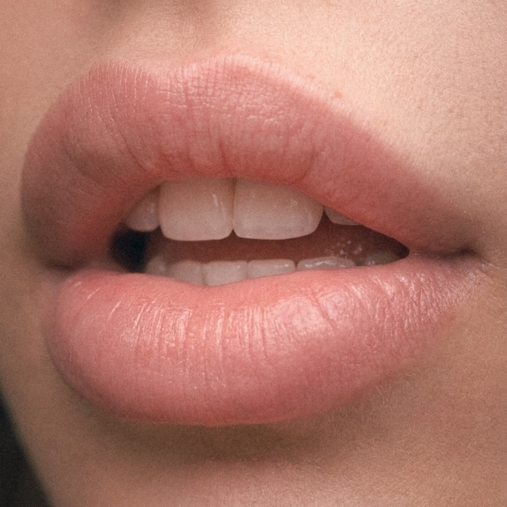 Lip Filler Dissolve at Renewed Essence Aesthetics and Wellness in San Antonio, TX