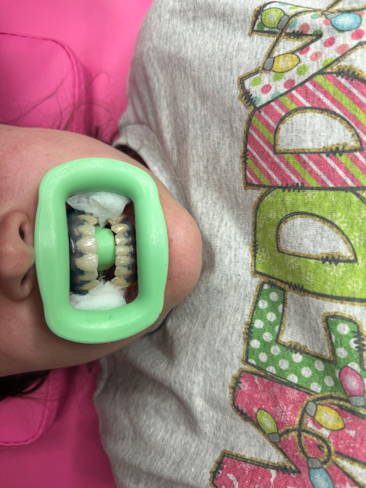 Teeth Whitening - NO NEW KIT