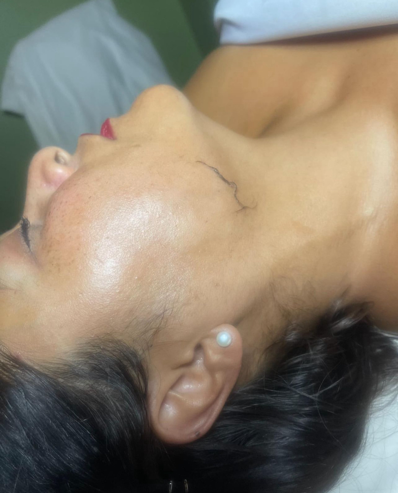 Dermaplaning (Add On)
