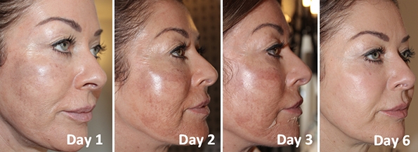 Derma Peel