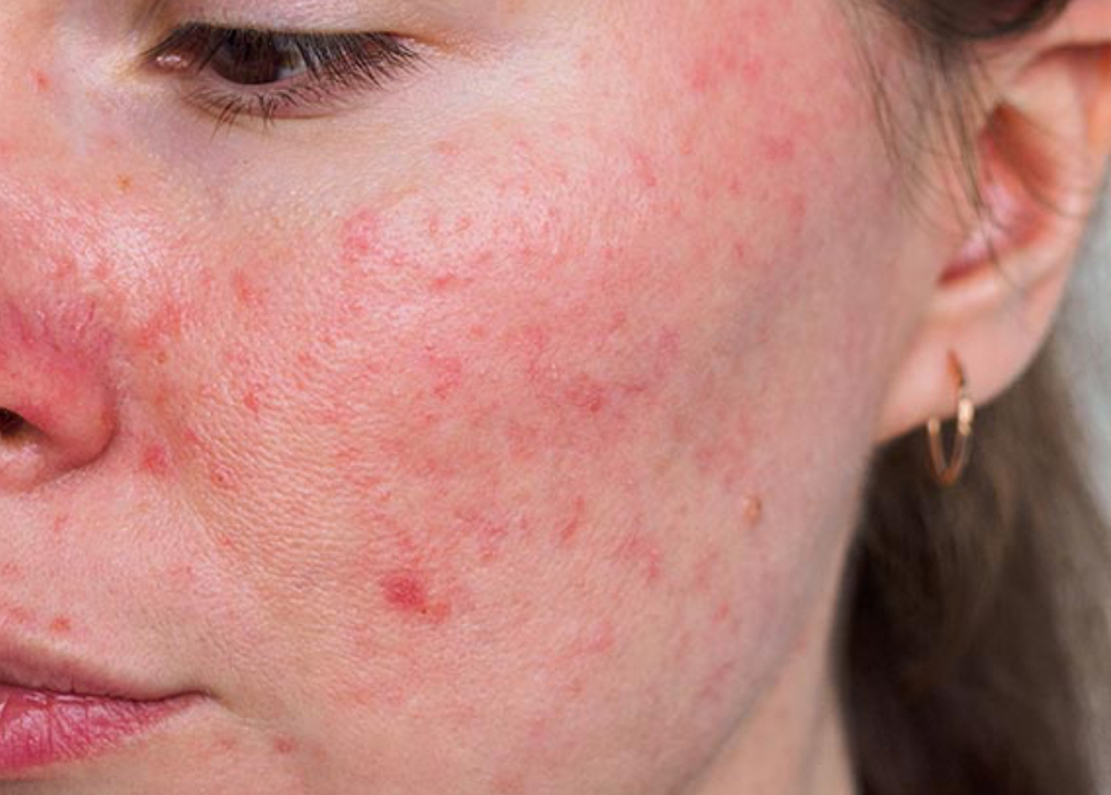 Simply Rosacea Facial