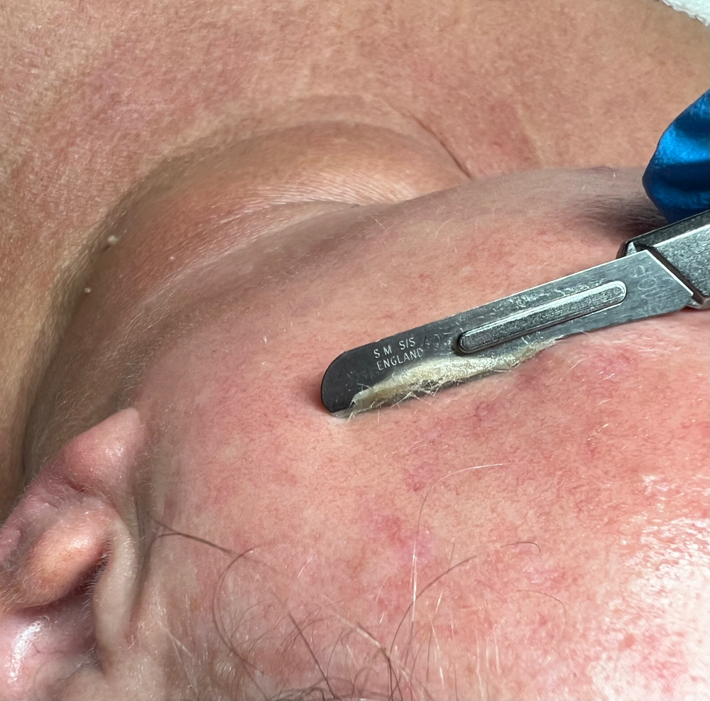 Dermaplaning Facial