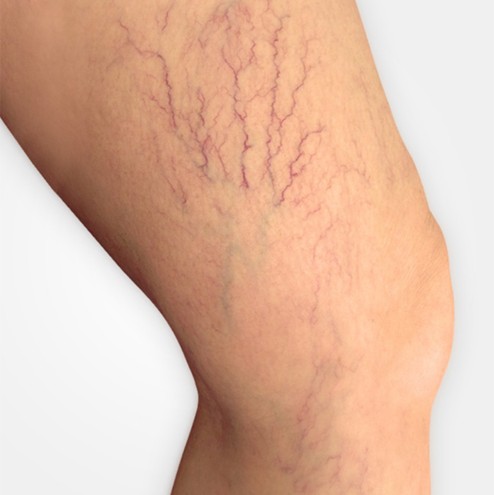 Telangiectasias-arañitas Vasculares at JB Beauty Studio in Lousville, KY