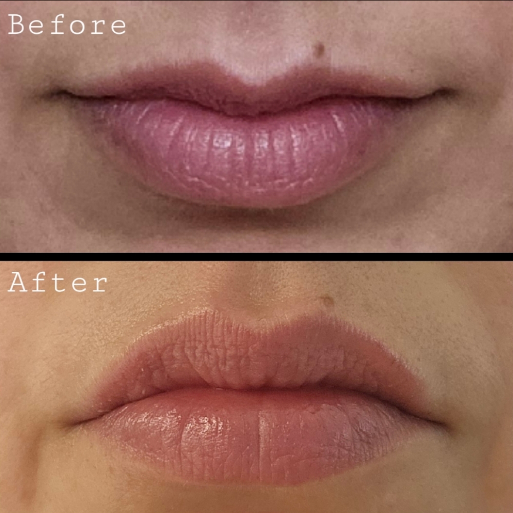 Lip Flip at Aesthetics by Malory in Lubbock, TX