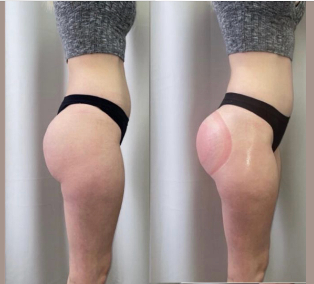 Non Surgical BBL