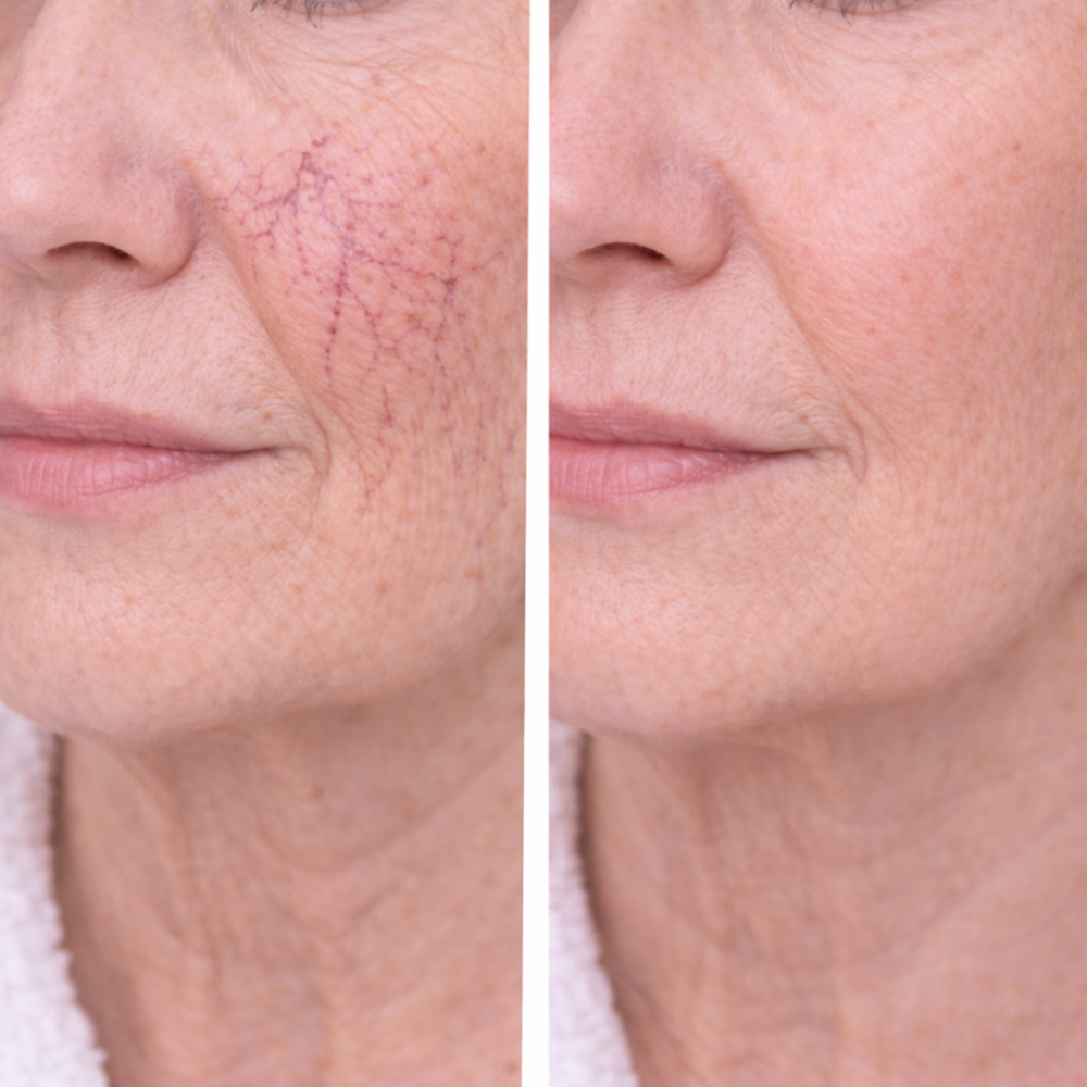 Vein Removal  - Small Area