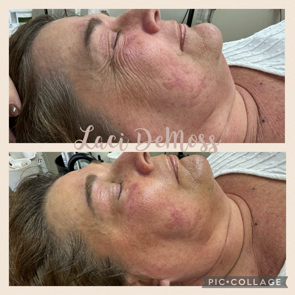 1 Cool Plasma Antiaging Face & Neck