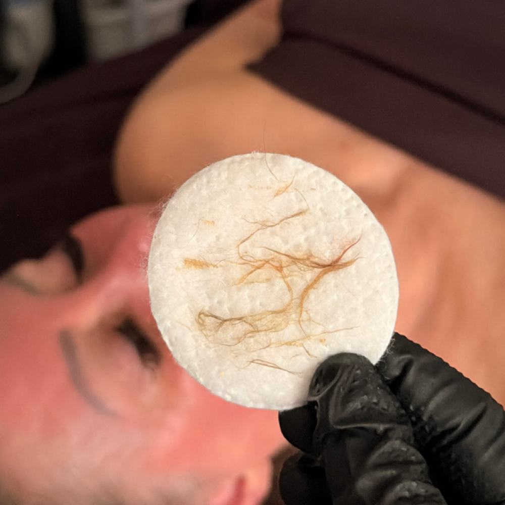 Dermaplaning at Esthetics By Karina in Oklahoma City, OK