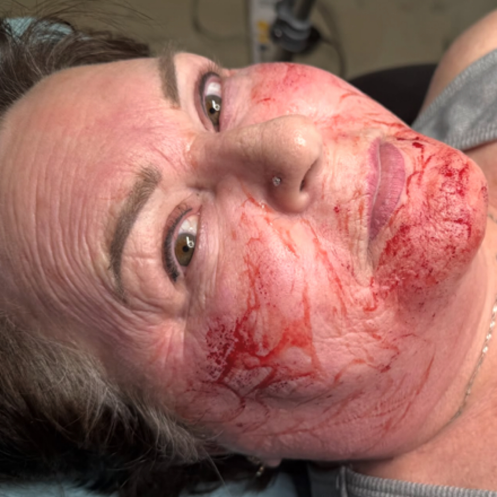 Microneedling with exosomes at Cosmetic Artistry in Lancaster, CA
