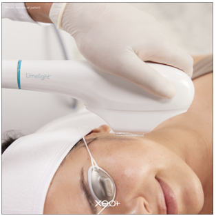 IPL Pigment | Sunspots | Brown Spot