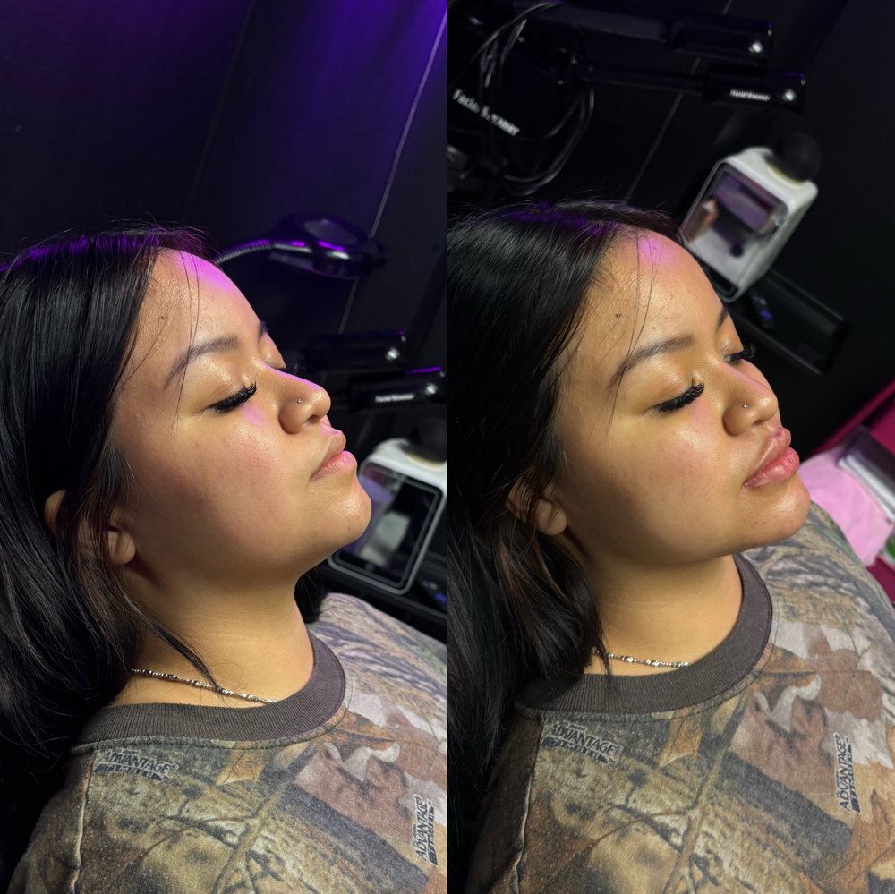 Mini Glow Up ✨Package at Perfection Injections in Euless, TX