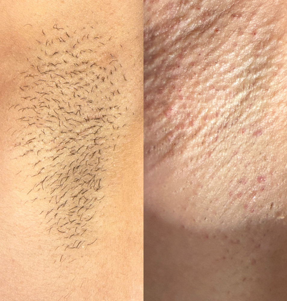 Underarm wax at Wax N Glow - South Plainfield, NJ in South Plainfield, NJ