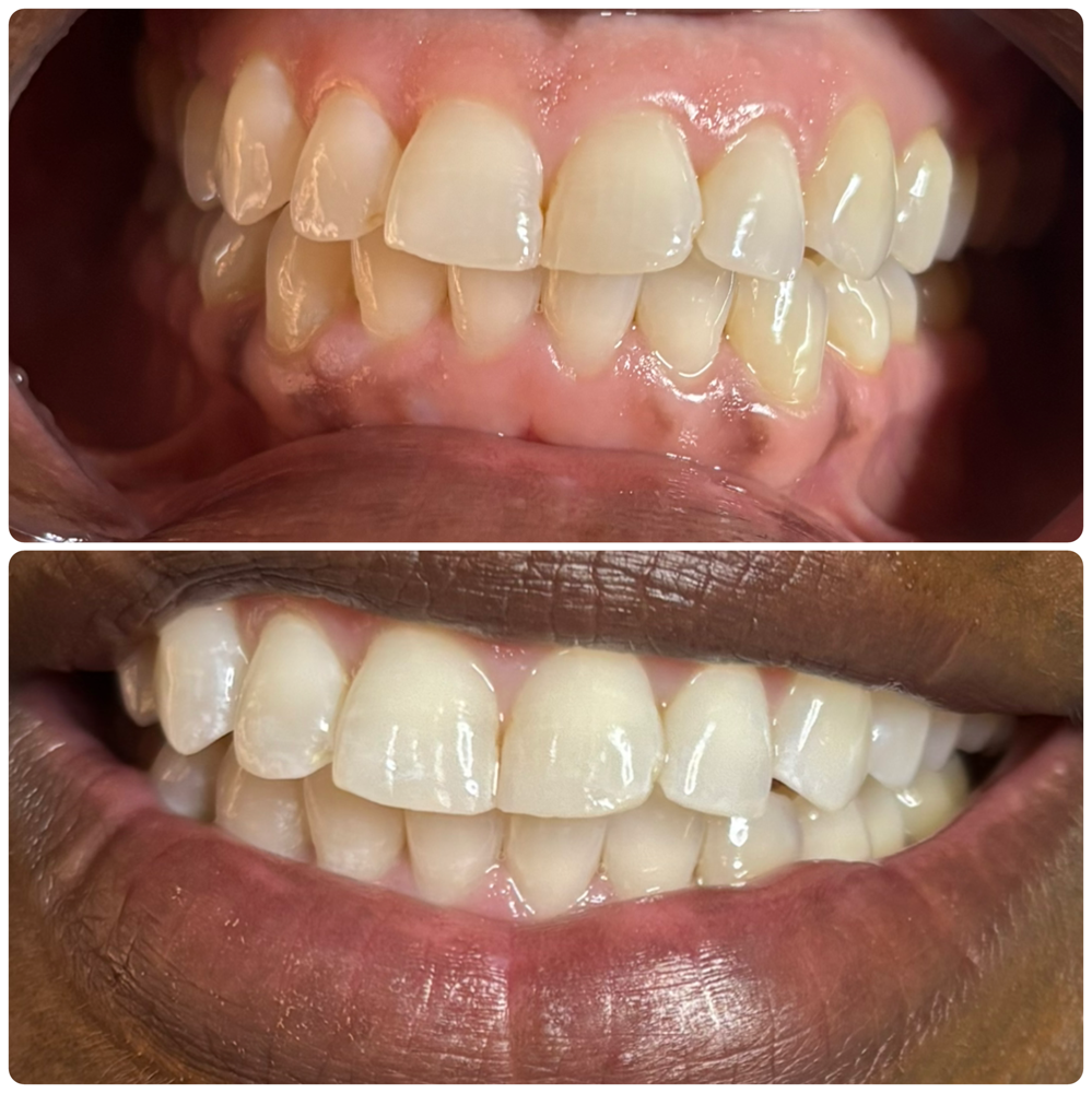1 Hour Teeth Whitening