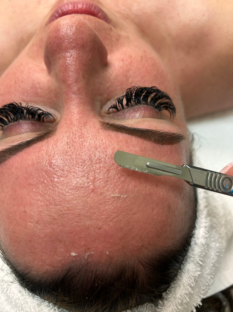 Dermaplane Facial