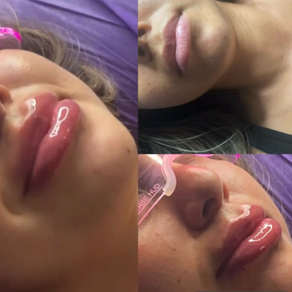 Lip Filler 1.1cc at Glo’s Beauty Creations